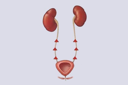 What is Vesicoureteral Reflux?
